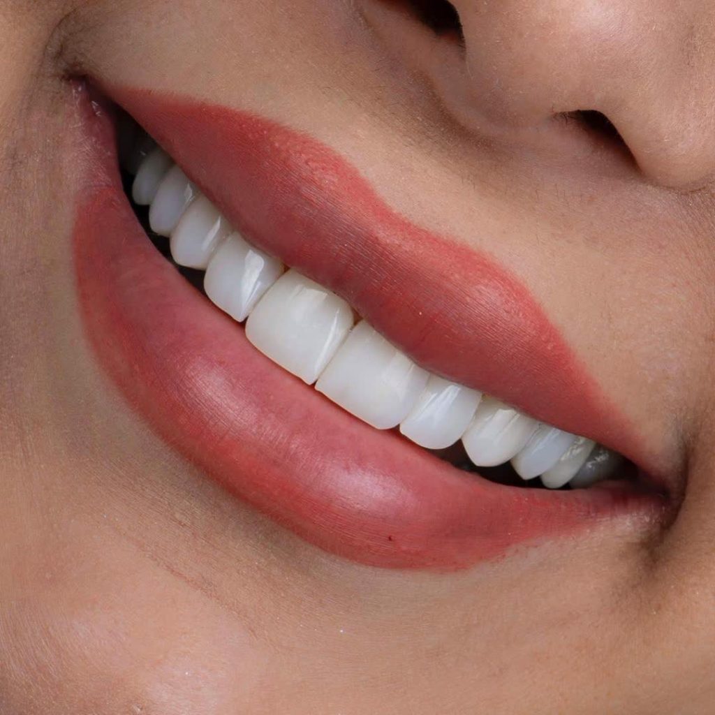 نمونه کار خدمات کامپوزیت دندان در پردیس